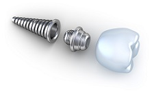 Cartoon of disassembled dental implant In Westminster, CO
